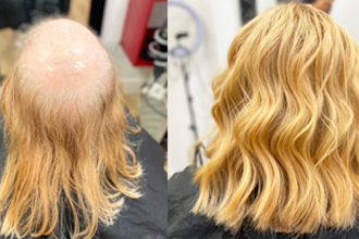 protese-capilar-feminina