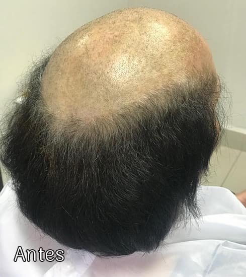 Protese-Capilar-feminina