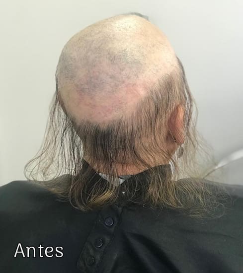 Protese-Capilar-feminina