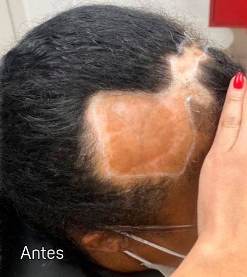 Protese-Capilar-feminina