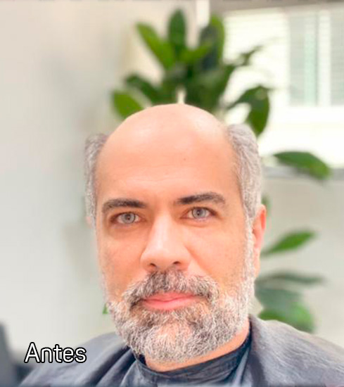 Protese-Capilar-masculino