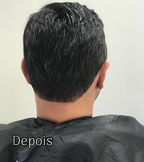 Protese-Capilar-masculino