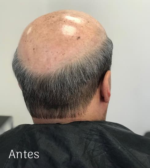 Protese-Capilar-masculino