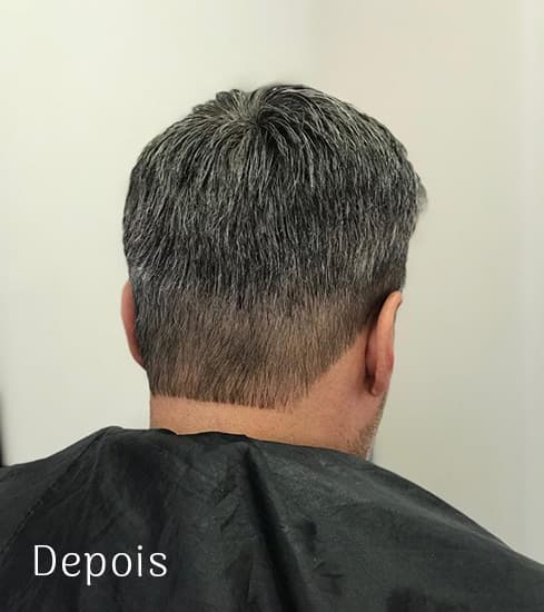 Protese-Capilar-masculino