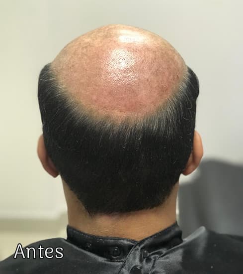 Protese-Capilar-masculino