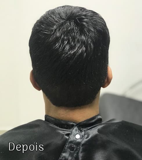 Protese-Capilar-masculino