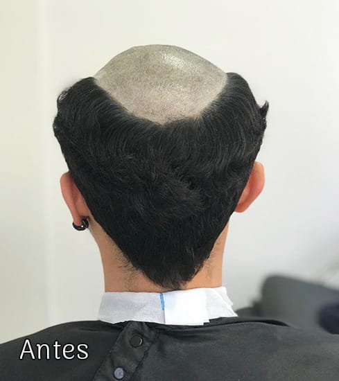 Protese-Capilar-masculino