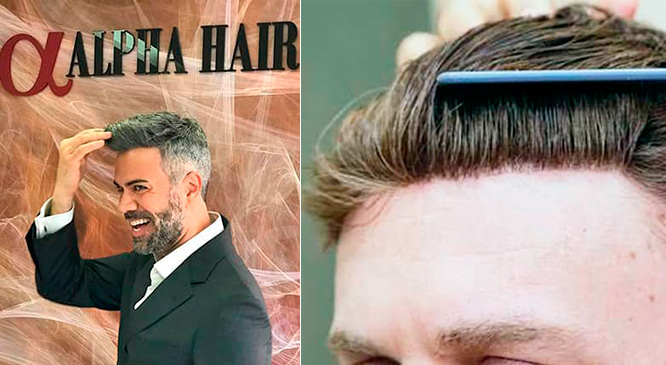 protese-capilar-masculino